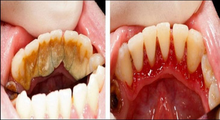 Klinik Tempat Membersihkan Karang Gigi Harga Terbaik  Sukmajaya Depok