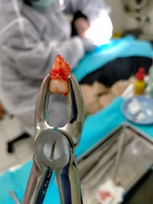 Klinik Tempat Pasang Gigi Palsu Terdekat  Limo Depok