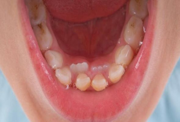 Harga Perawatan Gigi Terjangkau Di Beji Depok